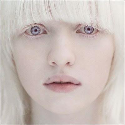 Niña con albinismo 