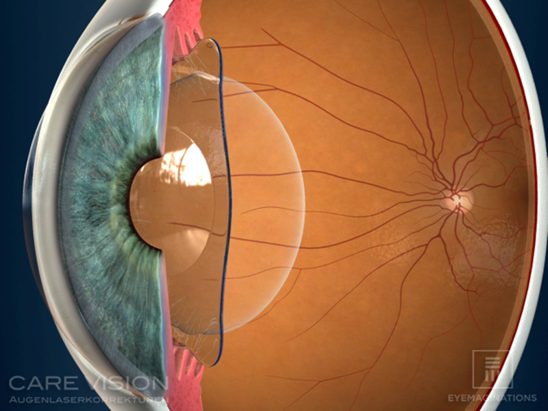 Sección ojo lente fáquica ICL