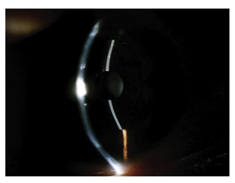 Primer plano lente Pinhole