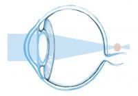 Hipermetropie viziune 0 5. Patologia de vedere redusă la copii: astigmatism, ce este?