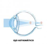 Ilustración ojo astigmático