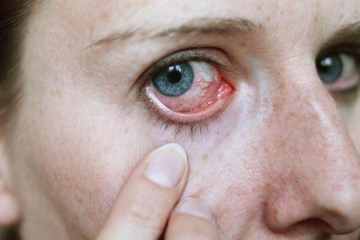 cuál es el síntoma de infección ocular cuál es el síntoma de infección ocular