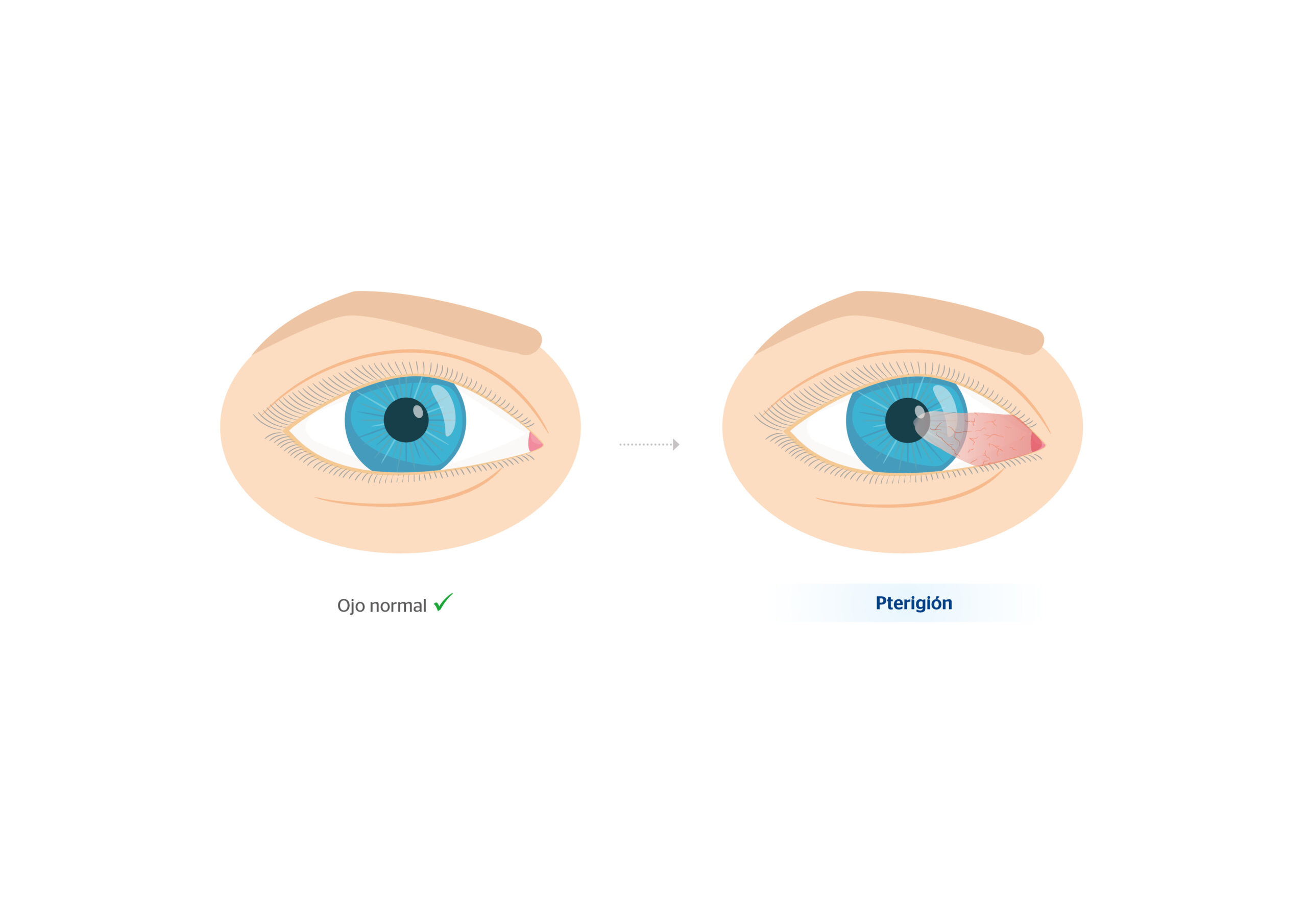 Ojo normal y ojo con pterigion