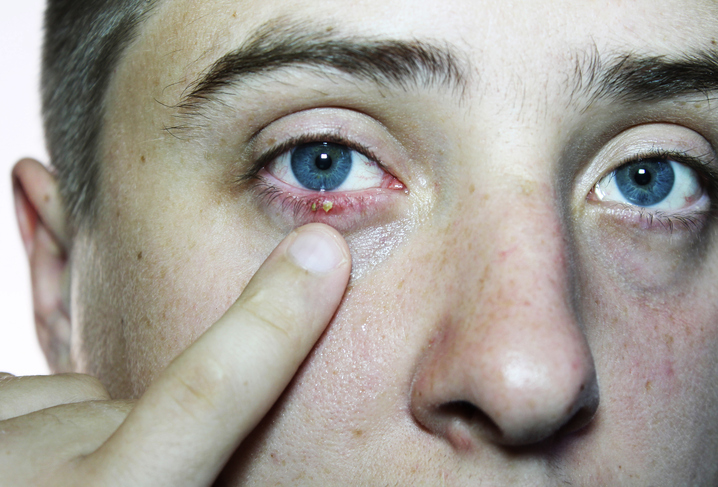 puntos de sangre en las ojeras puntos de sangre en las ojeras