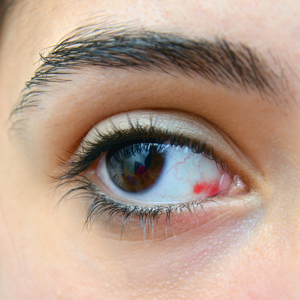 sangre+en+ojo+izquierdo
