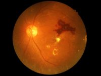Resultado prueba oftalmológica OCT
