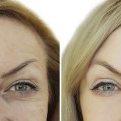 Blefaroplastia antes y después: descubre los cambios que se pueden lograr