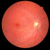 Mácula ocular: qué es y por qué es tan importante para la visión