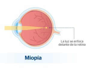 Miopía