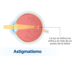Ojo con astigmatismo 