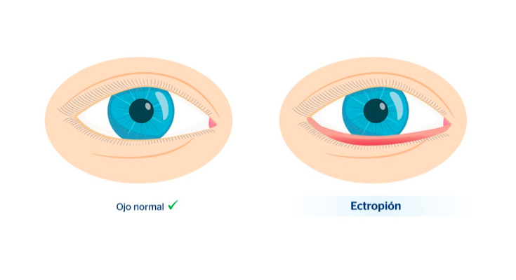 Ojo con ectropión y ojo normal 