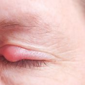 Manzanilla para el orzuelo: ¿Es un remedio que se puede usar para limpiar el ojo?