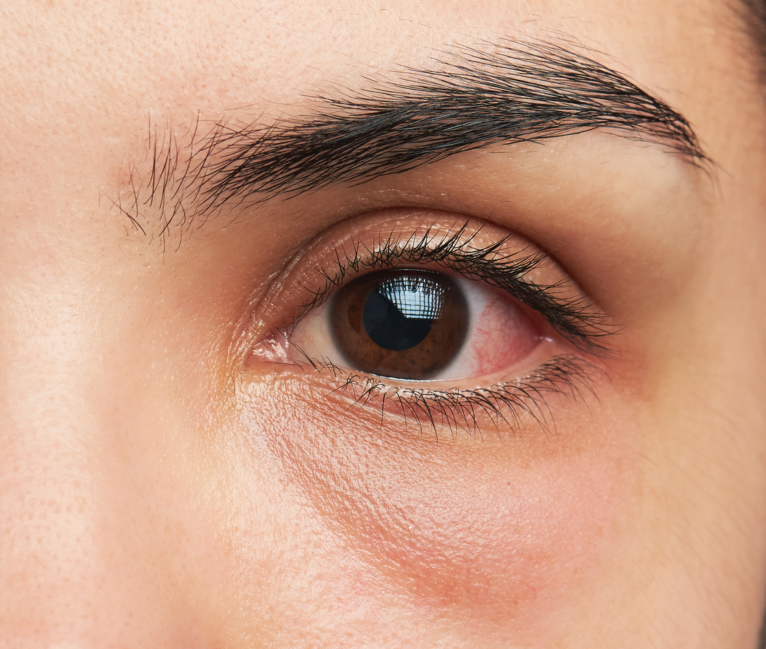 porque mi hijo tiene un punto rojo en el ojo porque mi hijo tiene un punto rojo en el ojo