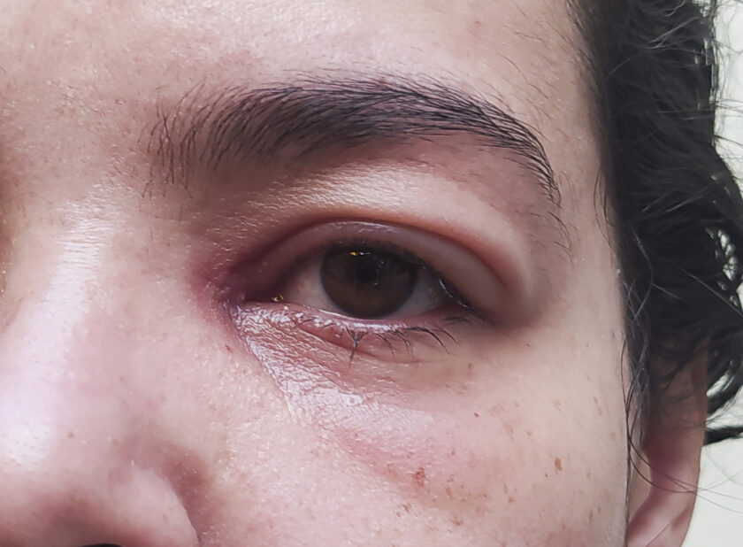 Párpado superior hinchado causas y tratamiento Blog de Clínica Baviera