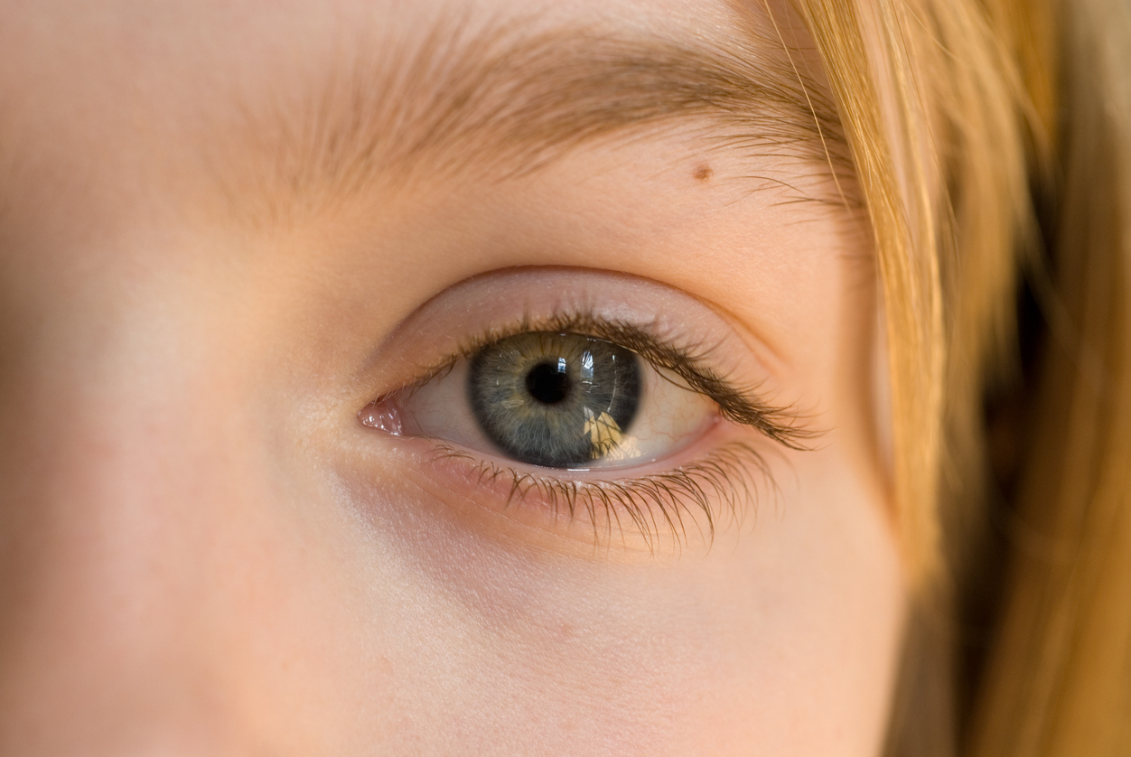 Niña con un lunar en el ojo