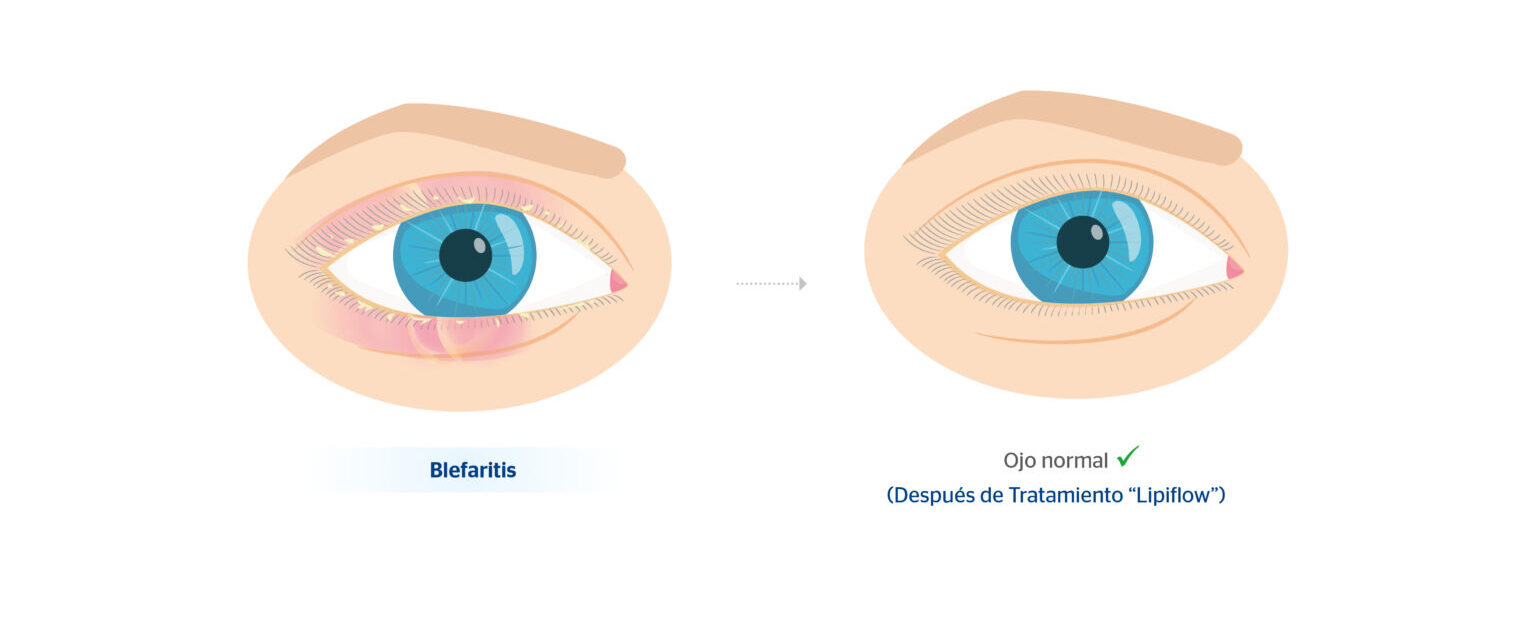 Ojo con blefaritis y ojo normal