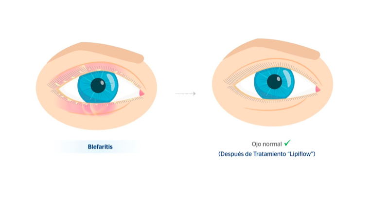 Ojo normal y ojo con blefaritis