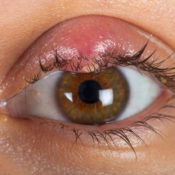 Orzuelo y lentillas: ¿pueden estar relacionados?