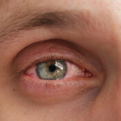 Mocos en los ojos o secreción ocular: ¿qué es?