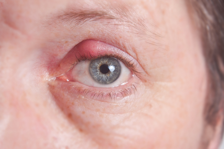 Primer plano de un ojo con el párpado inflamado