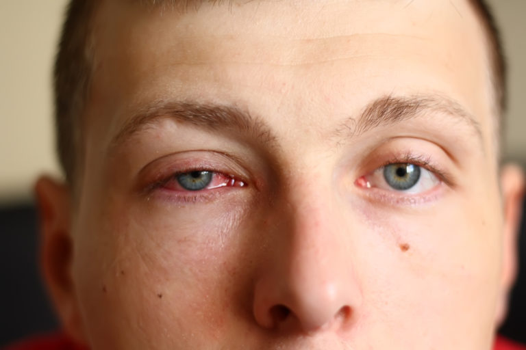 Conjuntivitis papilar gigante causas y tratamiento blog de cl nica