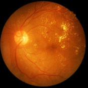 Enfermedad de Stargardt: la degeneración precoz de la retina