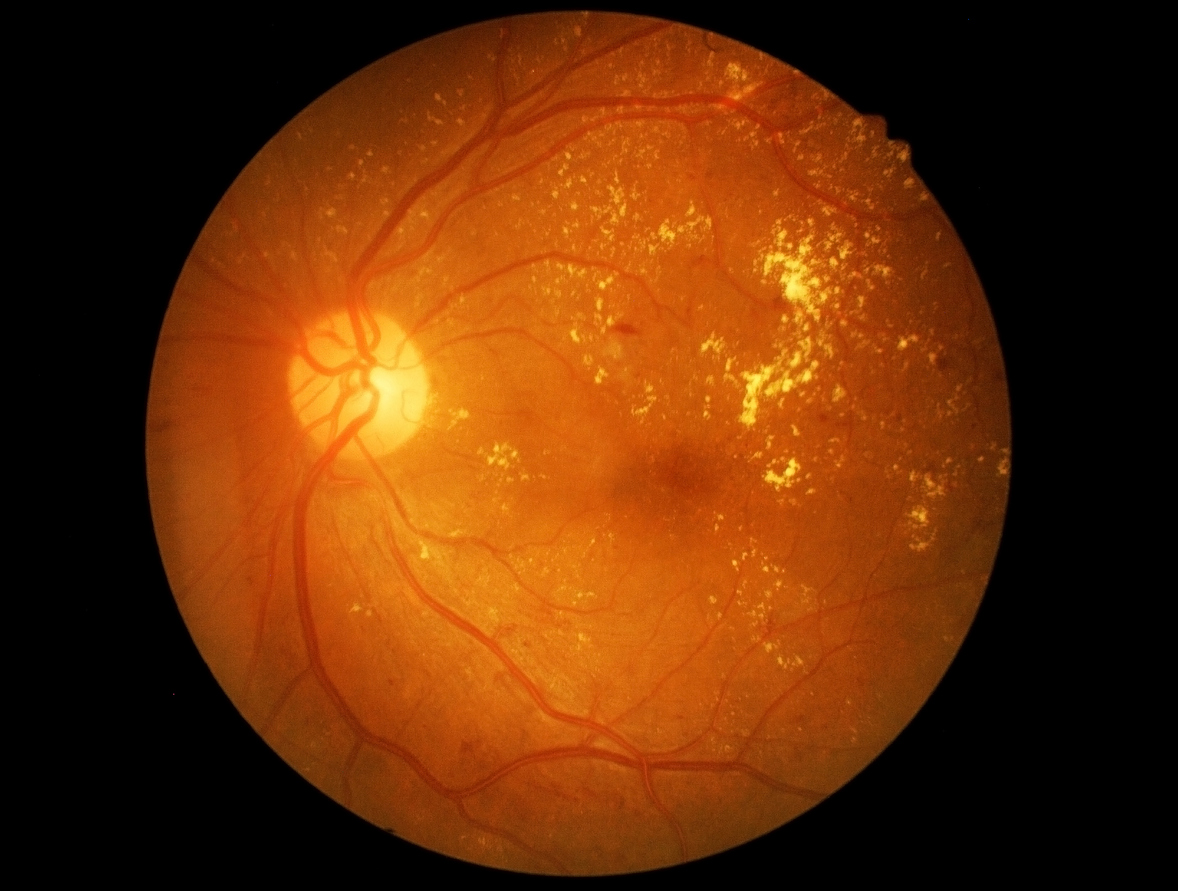Imagen de una retina