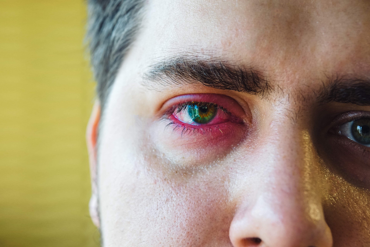párpado hinchado y dolor de cabeza