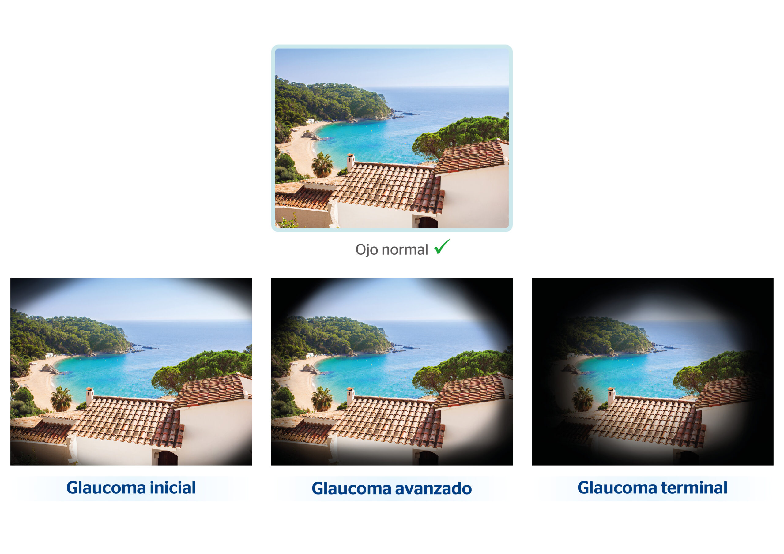 Síntomas del glaucoma en sus diferentes fases de evolución