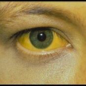 Ojos amarillos: causas y tratamiento para el color amarillento de esclerótica y piel
