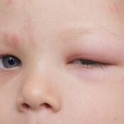 ¿Debo alarmarme si mi bebé tiene un ojo hinchado?