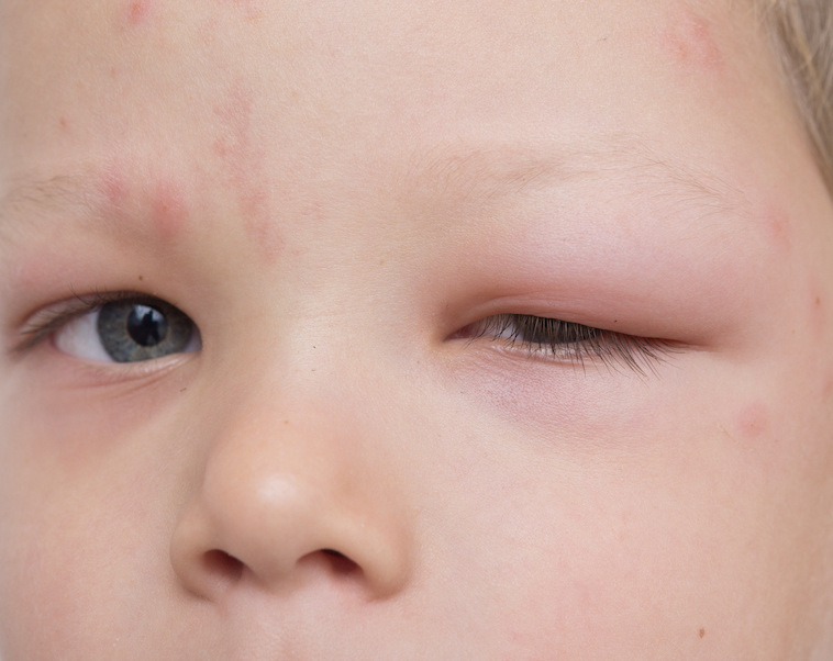 boleto energía raspador Ojos hinchados en niños: síntomas, causas y tratamiento