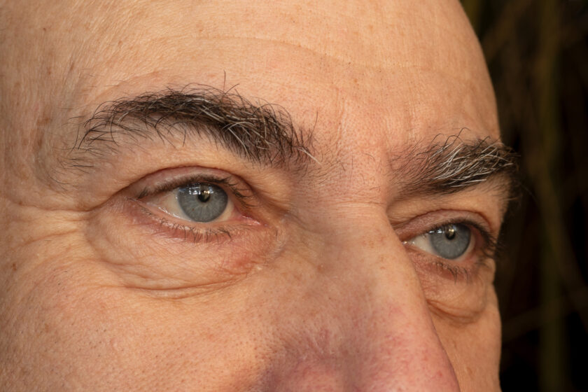 Qué es la DMAE y cómo se trata Blog de Clínica Baviera