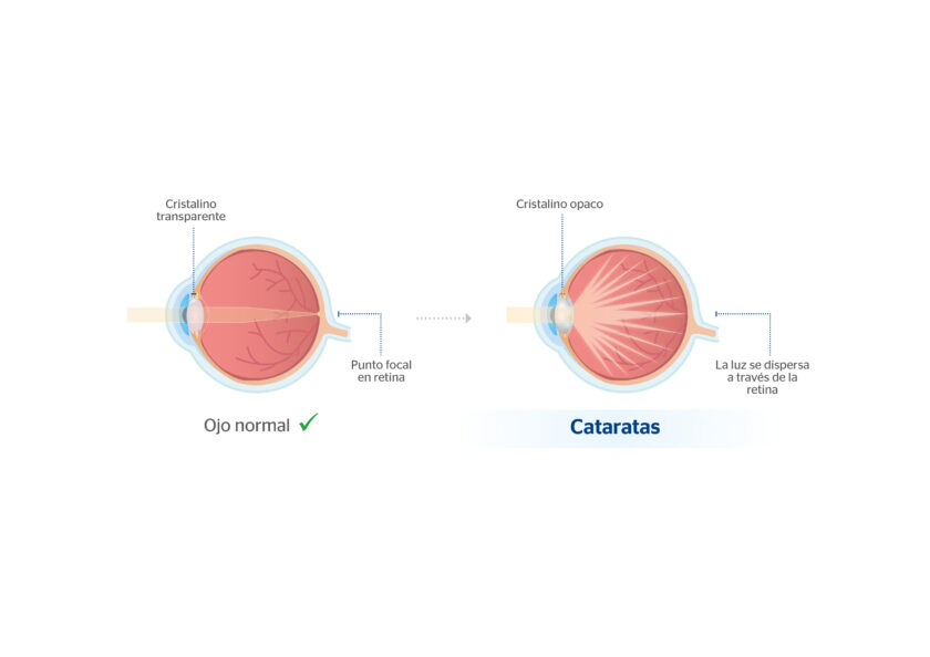 sucia lente intraocular? | Blog de Clínica