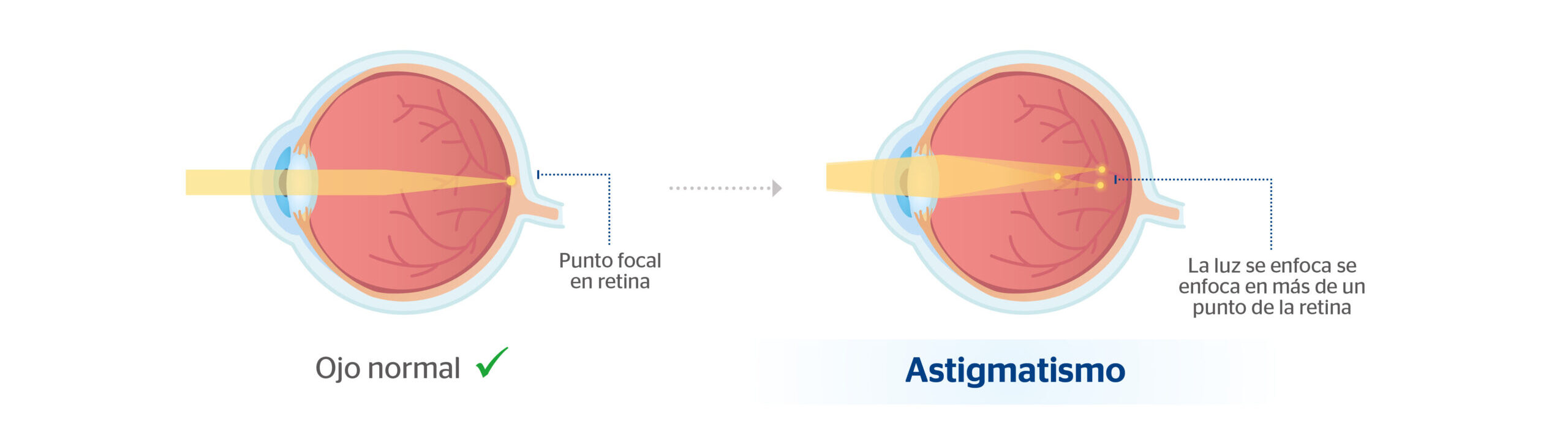 Ojo con astigmatismo y ojo normal
