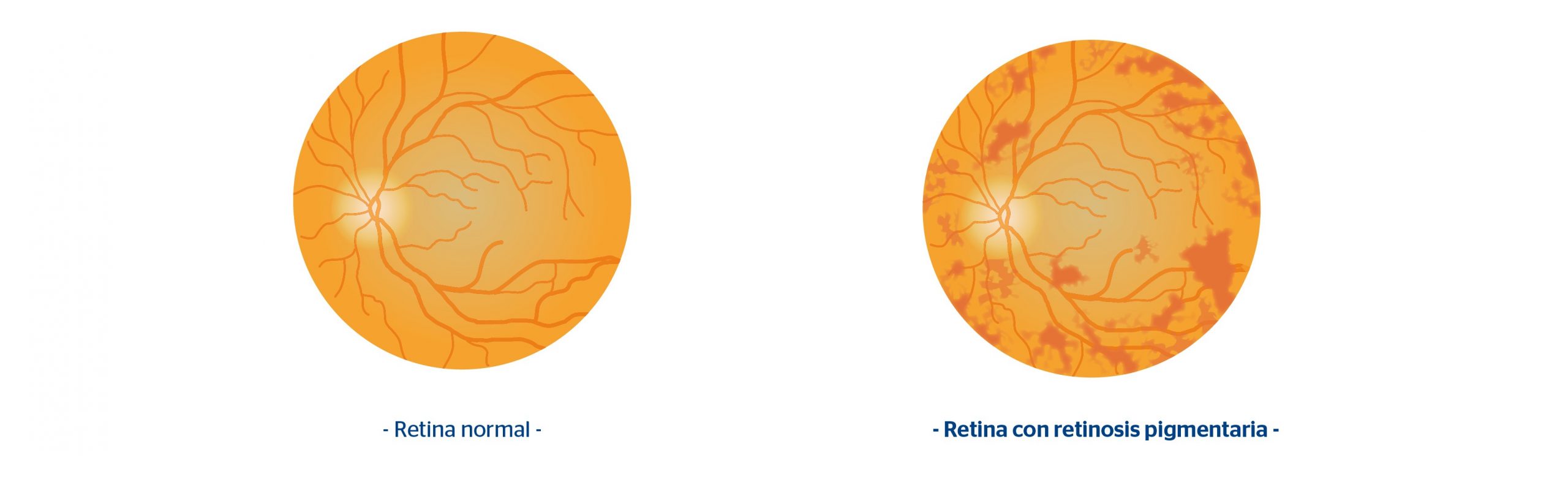 Retina normal y retina con retinosis pigmentaria