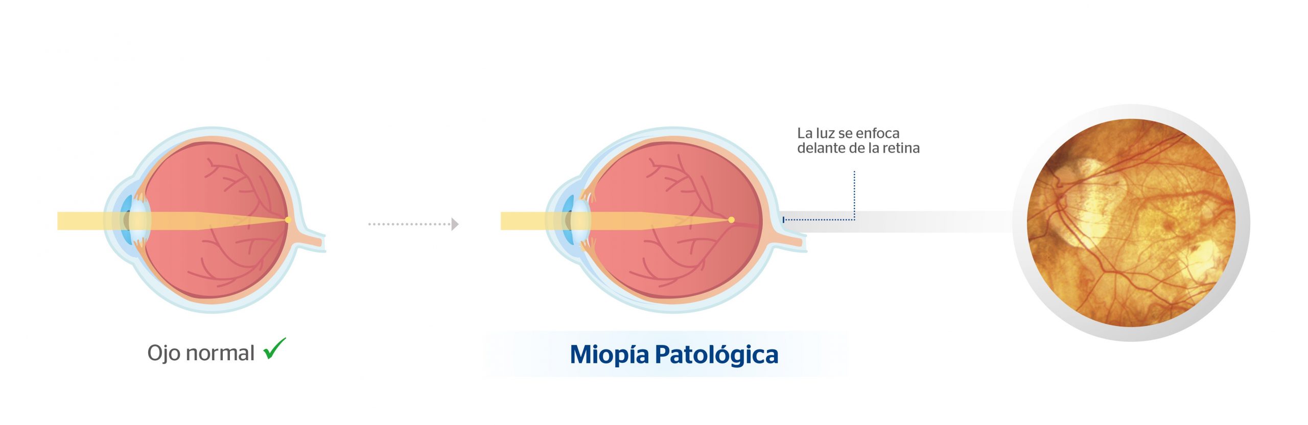 Ojo normal y ojo con miopía magna