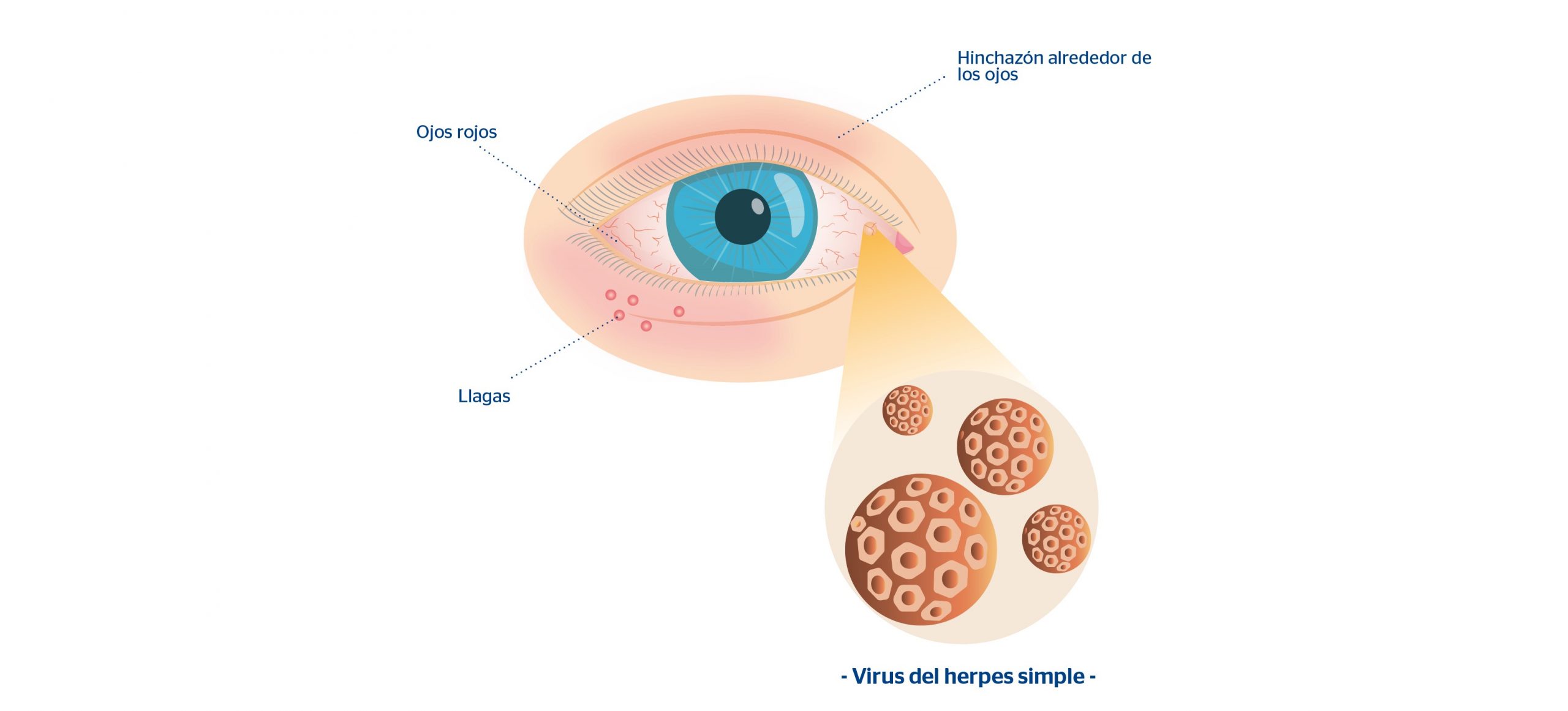 Ojo con virus del herpes simple