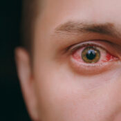 Herpes en el ojo: todo lo que tienes que saber al respecto