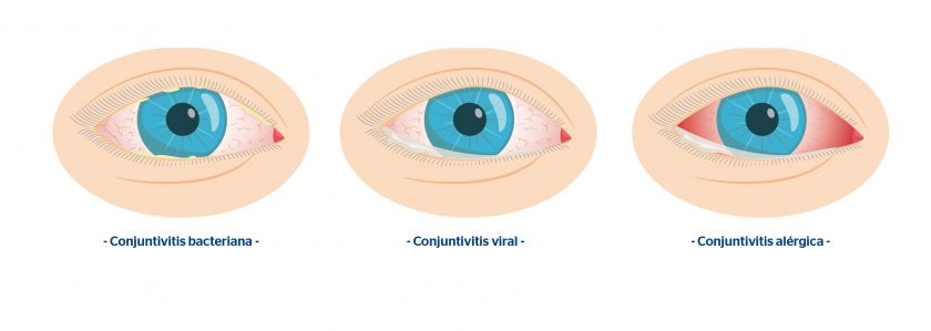 Alergia En Los Ojos Síntomas Y Tratamientos Blog De Clínica Baviera