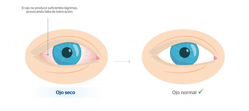 Alergia En Los Ojos Síntomas Y Tratamientos Blog De Clínica Baviera