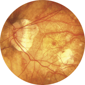 Fondo de ojo con miopía magna
